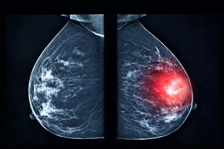 Ilustración de células tumorales de cáncer de mama en sangre con nuevos biomarcadores